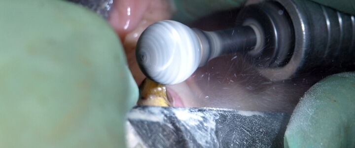 Abschleifen eines Hakenzahns