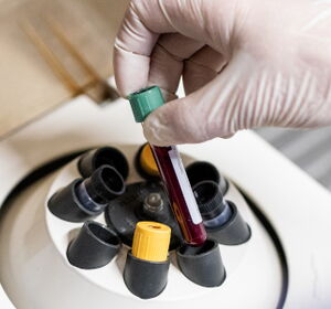 Herstellung von plättchenreichem Plasma in einer Zentrifuge